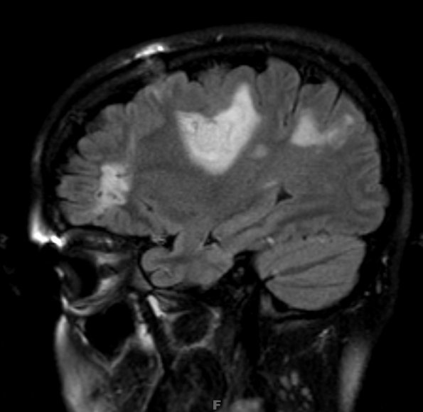 2A3 Balo Concentric Sclerosis (Case 2) FLAIR 2 - Copy