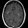 2A4 Balo Concentric Sclerosis (Case 2) T1 with contrast 4 - Copy