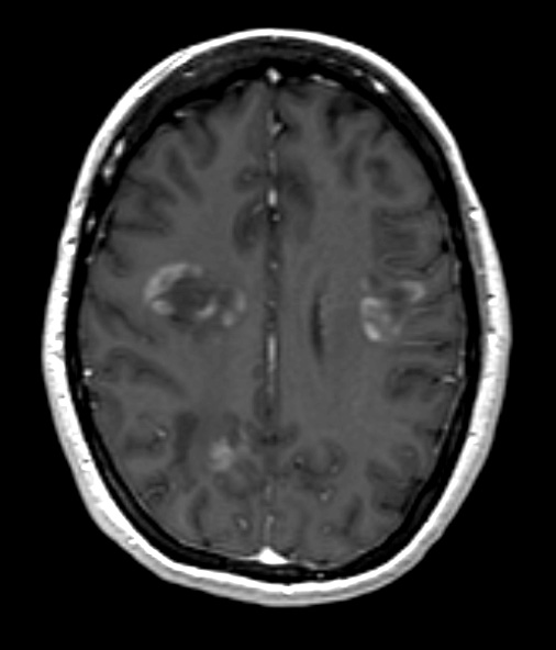 2A4 Balo Concentric Sclerosis (Case 2) T1 with contrast 4 - Copy