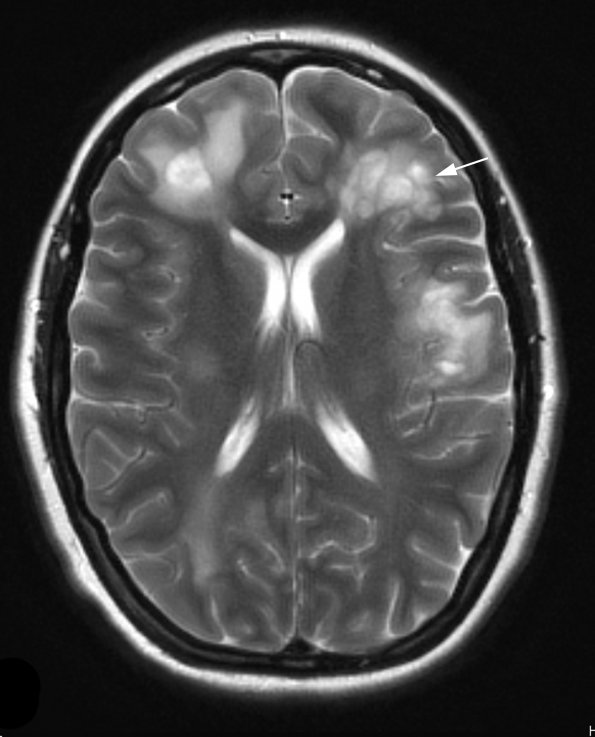 2A5 Balo Concentric Sclerosis (Case 2) T2 BLADE 4 copy - Copy