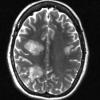 2A6 Balo Concentric Sclerosis (Case 2) T2 W (3) - Copy