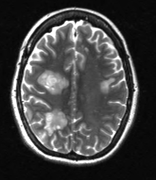 2A6 Balo Concentric Sclerosis (Case 2) T2 W (3) - Copy