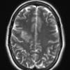 2B1 Balo Concentric Sclerosis (Case 2) T2 with contrast use for comparison - Copy