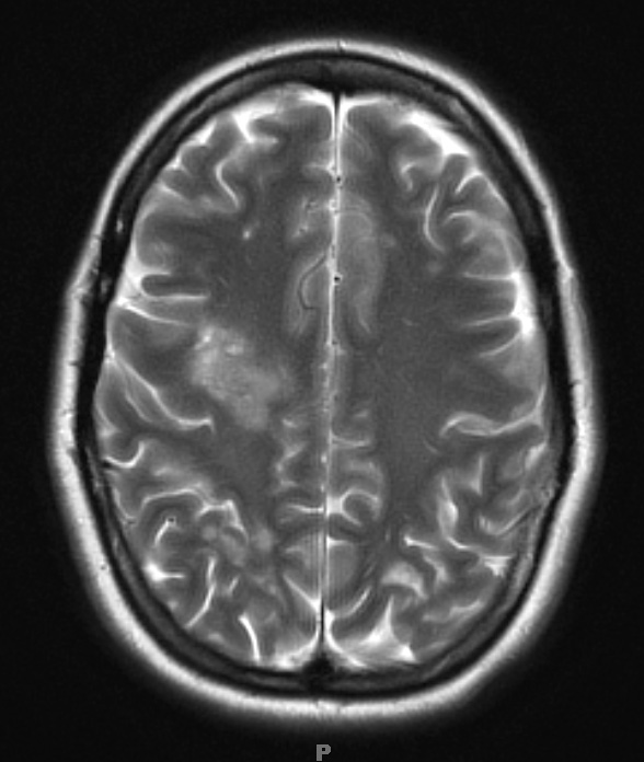 2B1 Balo Concentric Sclerosis (Case 2) T2 with contrast use for comparison - Copy