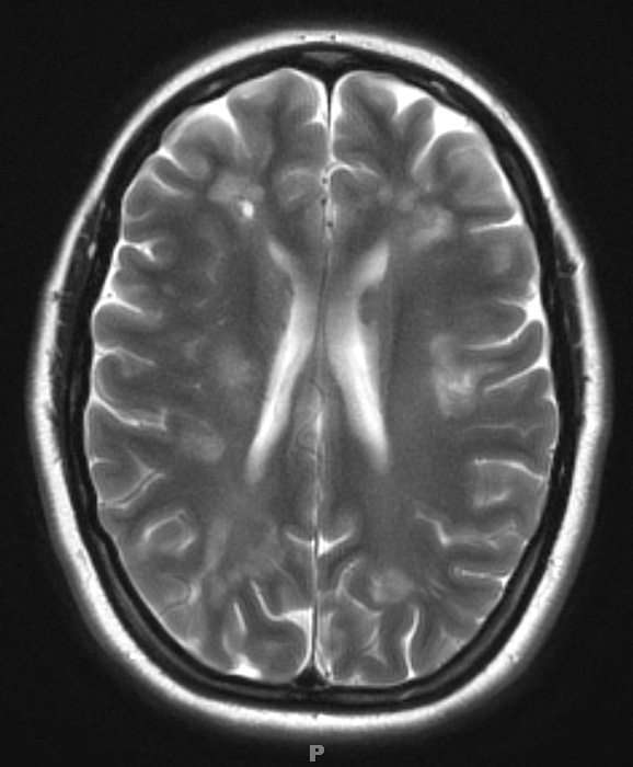 2B2 Balo Concentric Sclerosis (Case 2) T2 with contrast 4 months later 1 - Copy