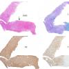 2C1 Balo Concentric Sclerosis (Case 2)  Composite 2