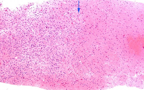 2C2 Balo Concentric Sclerosis (Case 2) Area A H&E 10X copy