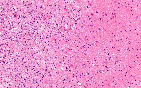 2C3 Balo Concentric Sclerosis (Case 2) Area A H&E 20X