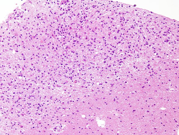 2C4 Balo Concentric Sclerosis (Case 2) H&E 5