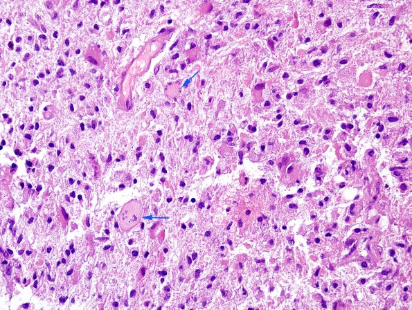 2C8 Balo Concentric Sclerosis (Case 2) H&E 4 copy