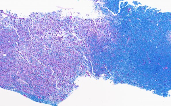 2D1 Balo Concentric Sclerosis (Case 2) Area A LFB-PAS 10X