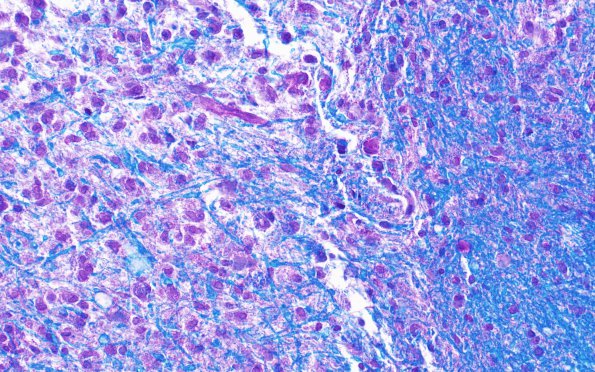 2D3 Balo Concentric Sclerosis (Case 2) Area A LFB-PAS 40X