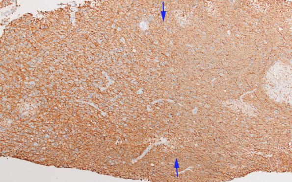 2E1 Balo Concentric Sclerosis (Case 2) Area A NF 10X copy