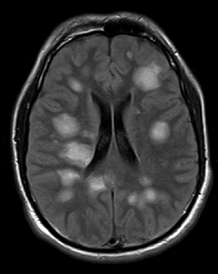 3A1 Balo Sclerosis (Claire Coire image, 2009 CANP Unknown 2) MRI T2 - CopyA