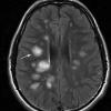 3A2 Balo Sclerosis (Claire Coire image, 2009 CANP Unknown 2) MRI T2 - CopyA