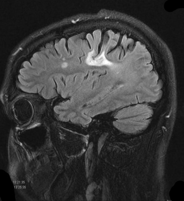 3A3 Balo concentric sclerosis FLAIR - Copy