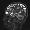 3A4 Balo Sclerosis (Claire Coire image, 2009 CANP Unknown 2) MRI T2 - CopyA