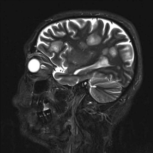 3A4 Balo Sclerosis (Claire Coire image, 2009 CANP Unknown 2) MRI T2 - CopyA