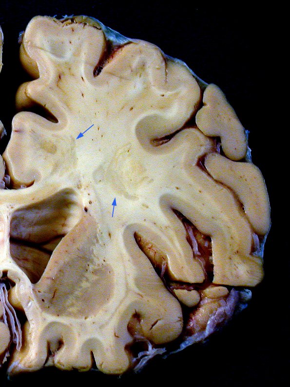 3B1 Balo Sclerosis (Claire Coire image, 2009 CANP Unknown 2) gross Hemisphere 1 copy - Copy