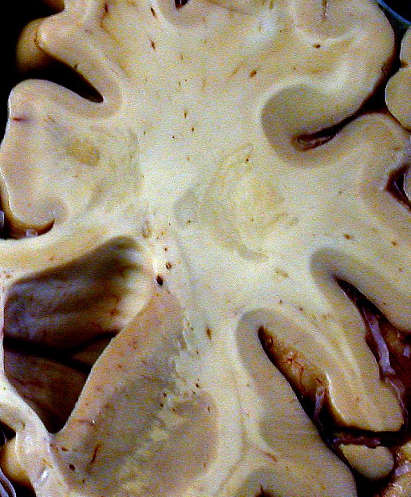 3B2 Balo Sclerosis (Claire Coire image, 2009 CANP Unknown 2) gross 1 (cropped) A - Copy