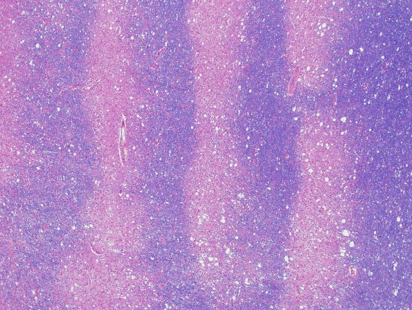 3D1 Balo Concentric Sclerosis (slide Claire Coire) original H&E 6