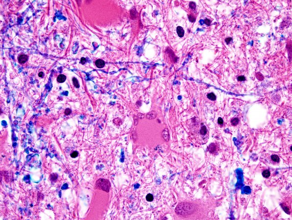 3D8 Balo Concentric Sclerosis (2009 CANP Unknown #2) H&E-LFB 100X 4