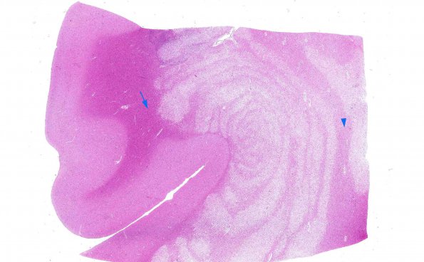 4A1 Balo Concentric Sclerosis (AANP 2015 Case 3) H&E 17 copy