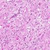 4B2 Balo Concentric Sclerosis (AANP 2015 Case 3) H&E 17.8X