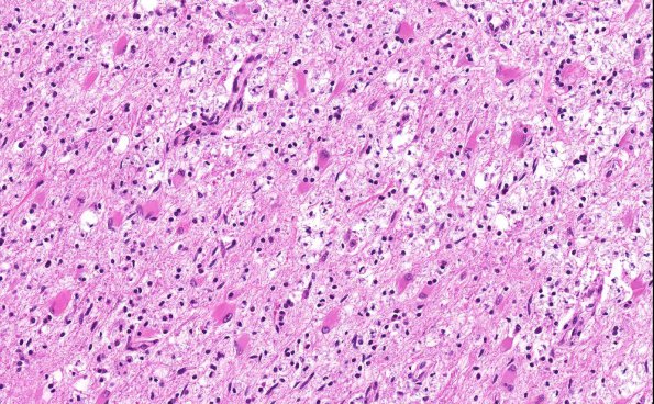 4B2 Balo Concentric Sclerosis (AANP 2015 Case 3) H&E 17.8X