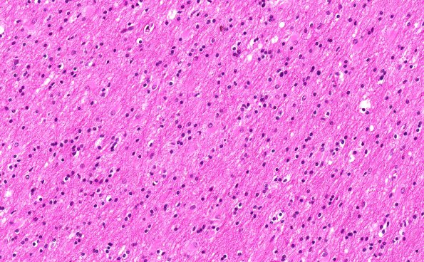 4B3 Balo Concentric Sclerosis (AANP 2015 Case 3) H&E 17.8X normal WM