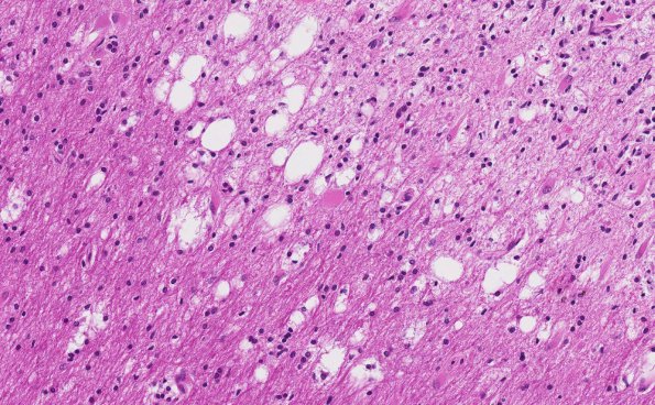 4B4 Balo Concentric Sclerosis (AANP 2015 Case 3) H&E 17.8X normal WM