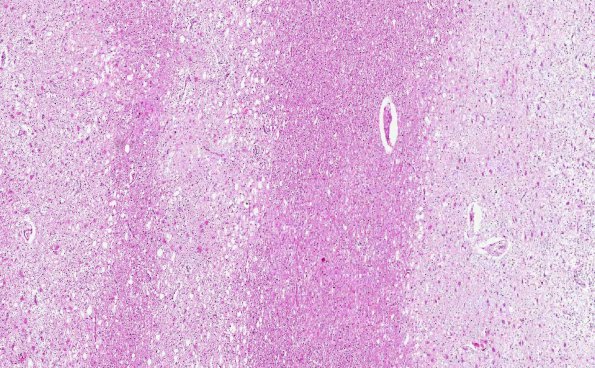 4C1 Balo Concentric Sclerosis (AANP 2015 Case 3) H&E 3.4X