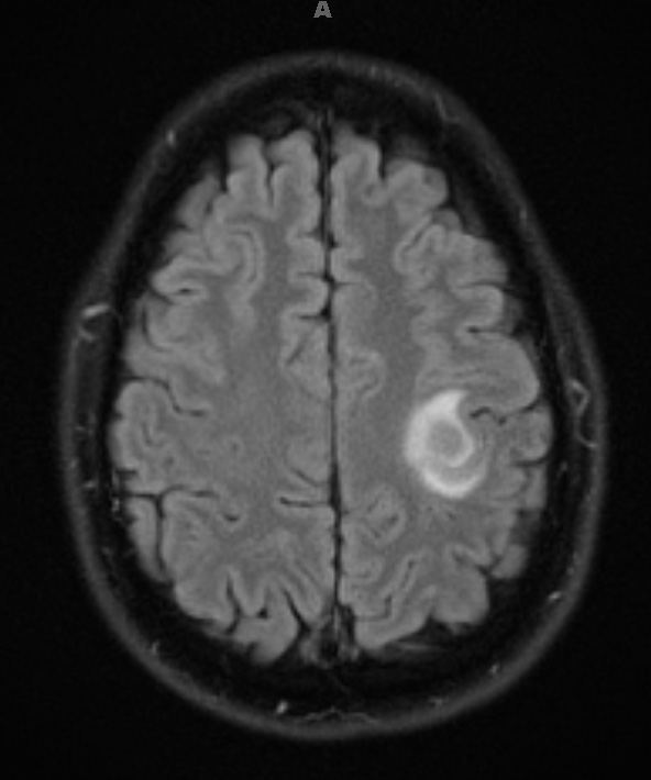 11A1 MS, Tumefactive (Case 11) FLAIR - Copy