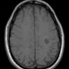 11A2 MS, Tumefactive (Case 11) T1 no contrast - Copy