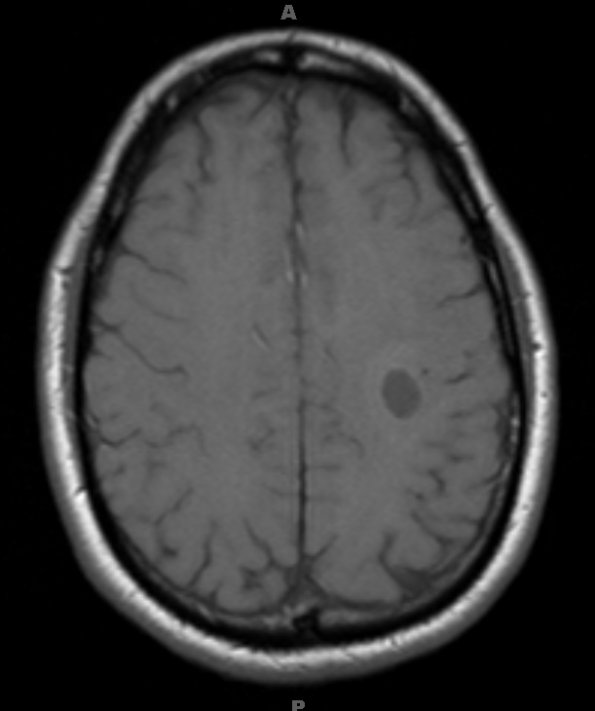 11A2 MS, Tumefactive (Case 11) T1 no contrast - Copy