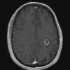 11A3 MS, Tumefactive (Case 11) T1 with contrast - Copy