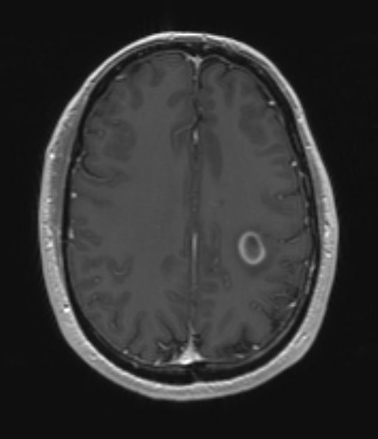 11A3 MS, Tumefactive (Case 11) T1 with contrast - Copy