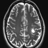 11A4 MS, Tumefactive (Case 11) T2 with contrast - Copy