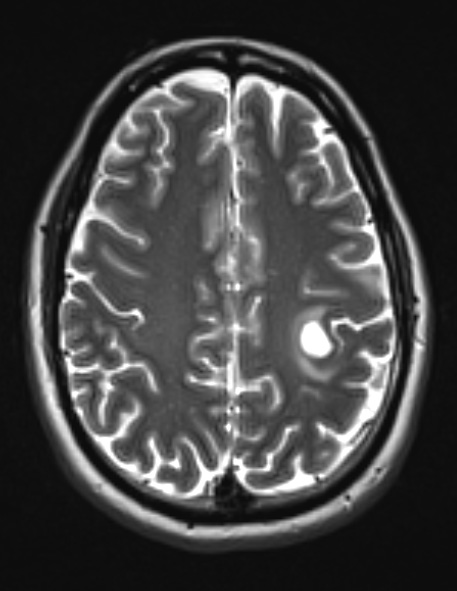 11A4 MS, Tumefactive (Case 11) T2 with contrast - Copy