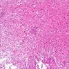 11B1 Inflammatory Demyelination (Tumefactive MS, Case 11) H&E 3