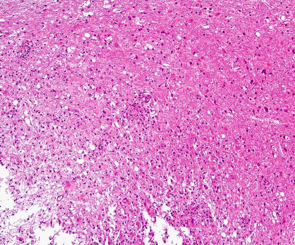 11B1 Inflammatory Demyelination (Tumefactive MS, Case 11) H&E 3