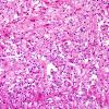 11B2 Inflammatory Demyelination (Tumefactive MS, Case 11) H&E frozen 2