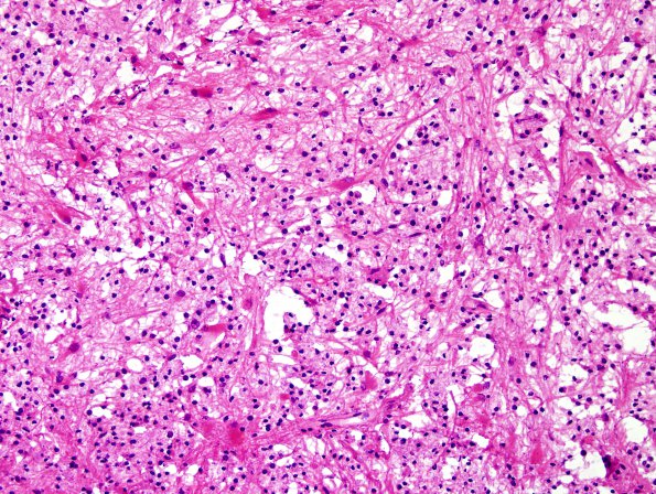 11B2 Inflammatory Demyelination (Tumefactive MS, Case 11) H&E frozen 2