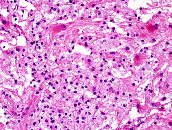 11B3 Inflammatory Demyelination (Tumefactive MS, Case 11) H&E 4