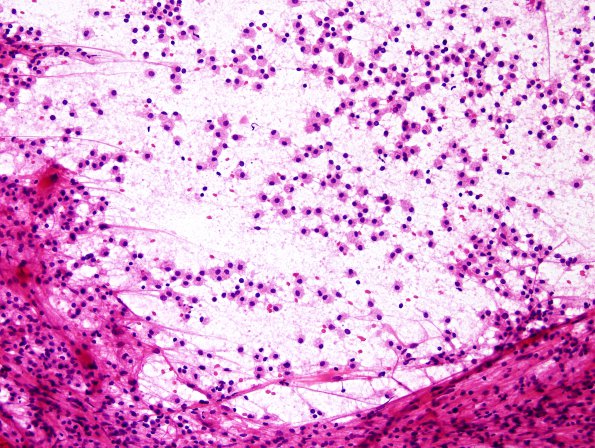 11B4 Inflammatory Demyelination (Tumefactive MS, Case 11) H&E smear 2