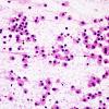 11B5 Inflammatory Demyelination (Tumefactive MS, Case 11) H&E smear 1