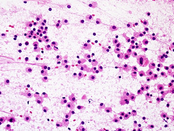 11B5 Inflammatory Demyelination (Tumefactive MS, Case 11) H&E smear 1