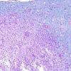 11C1 Inflammatory Demyelination (Tumefactive MS, Case 11) LFB-PAS 5