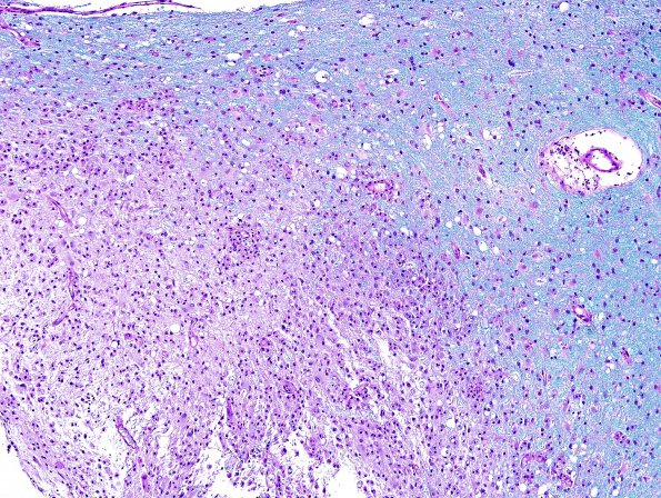 11C1 Inflammatory Demyelination (Tumefactive MS, Case 11) LFB-PAS 5