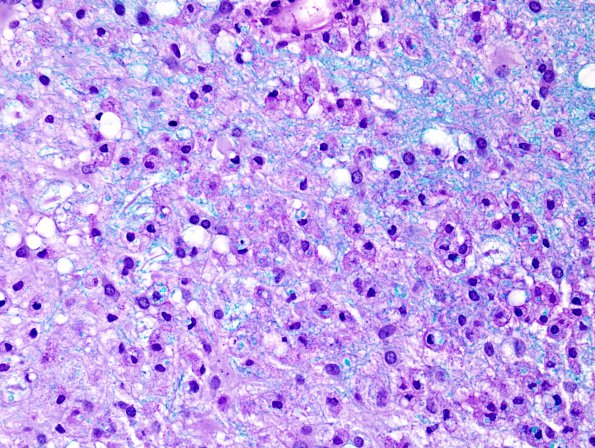 11C2 Inflammatory Demyelination (Tumefactive MS, Case 11) LFB-PAS 1